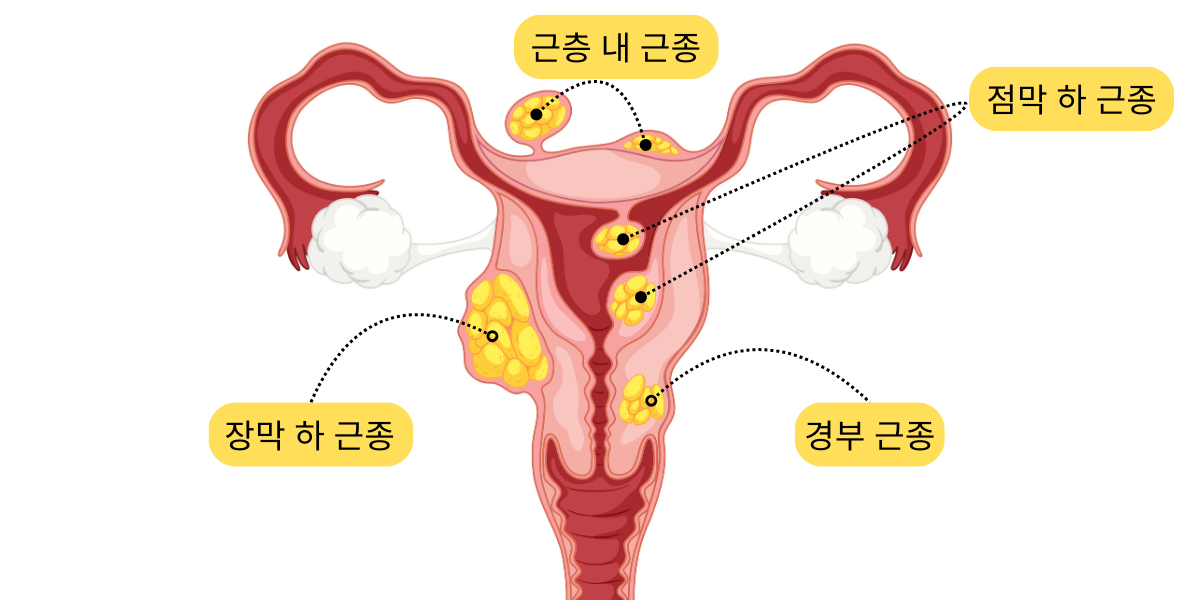 자궁에 혹, 자궁 근종 종류
